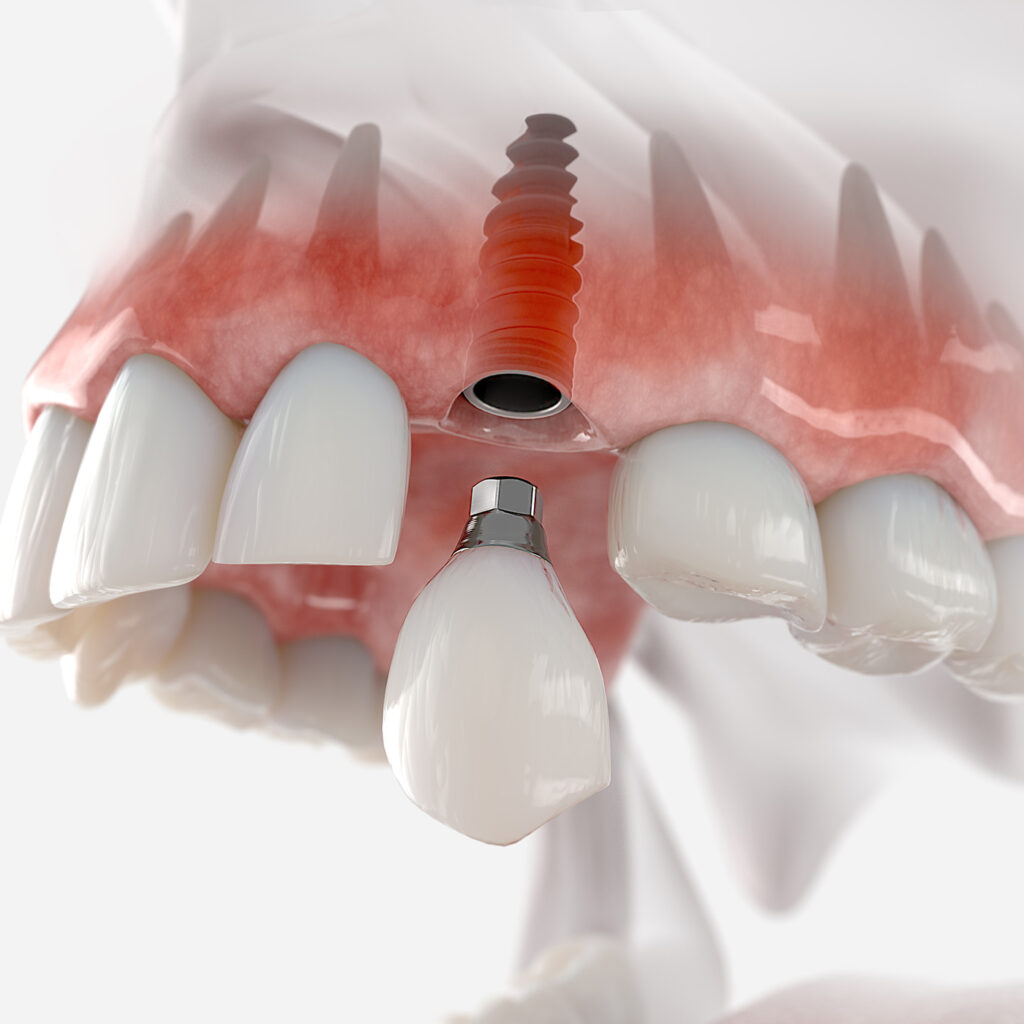 dental-implants-4