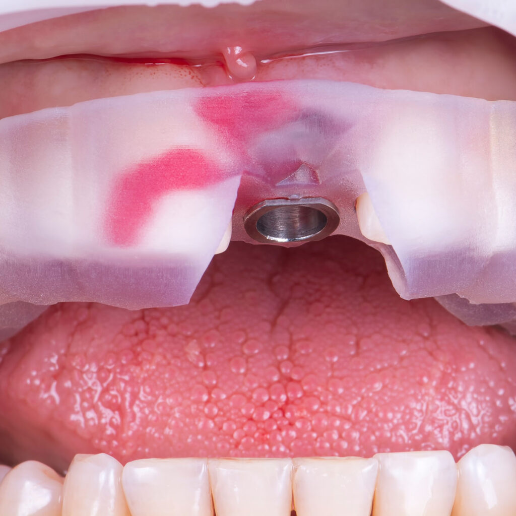 dental-implants4
