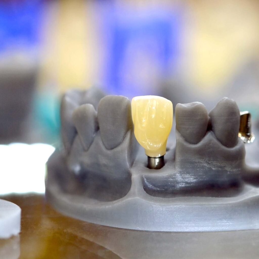 dental-implants5